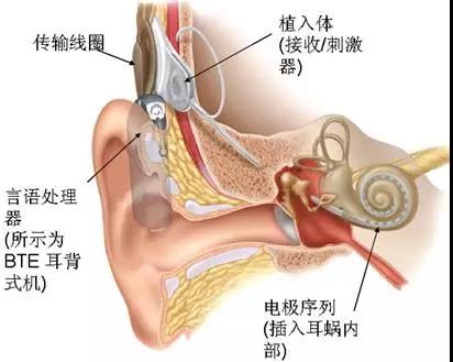助听器和人工耳蜗的区别