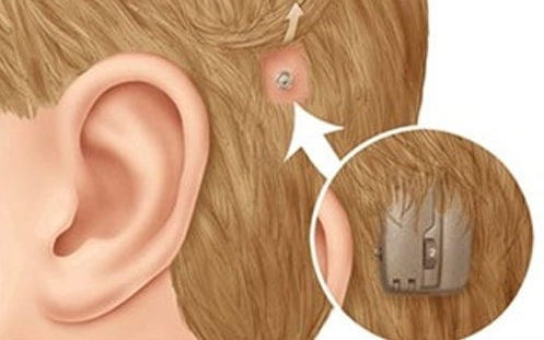 　　什么是骨导助听器？骨导助听器的原理是什么？
