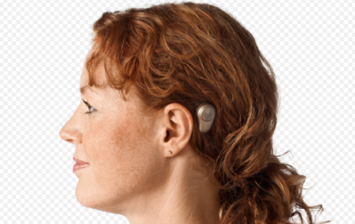 骨锚助听器（BAHA）适合人群以及缺点