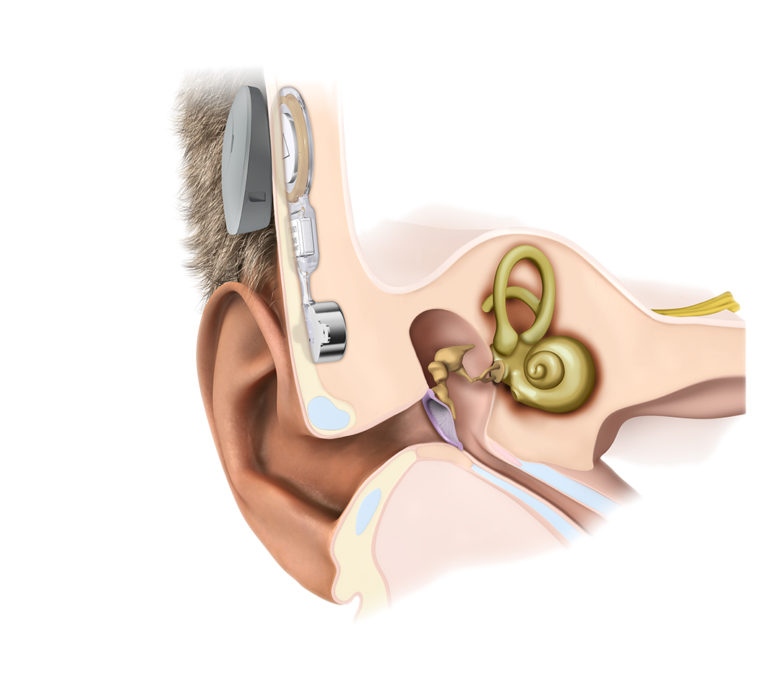 2什么是骨传导助听器？骨传导助听器的工作原理